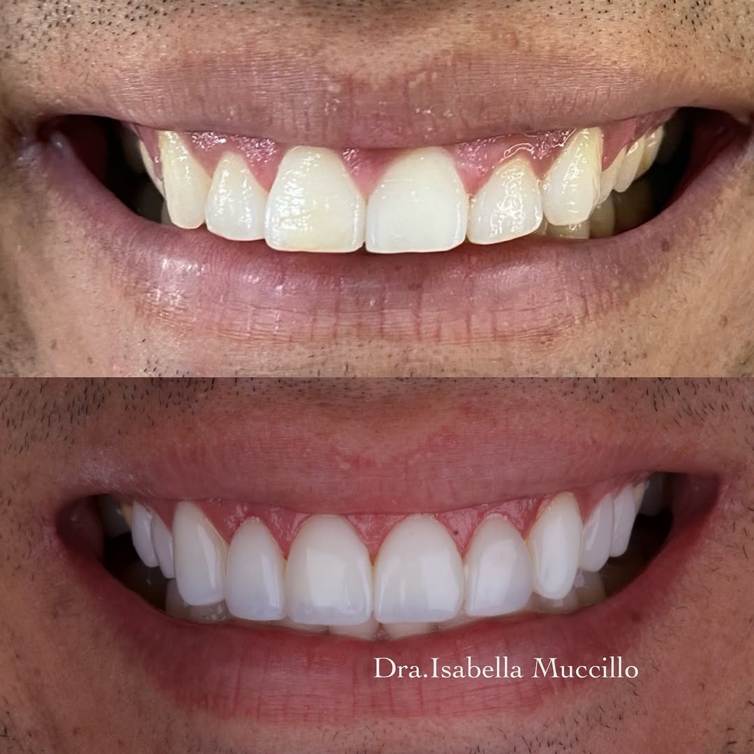 Sorriso Planejado em Detalhes (antes e depois)